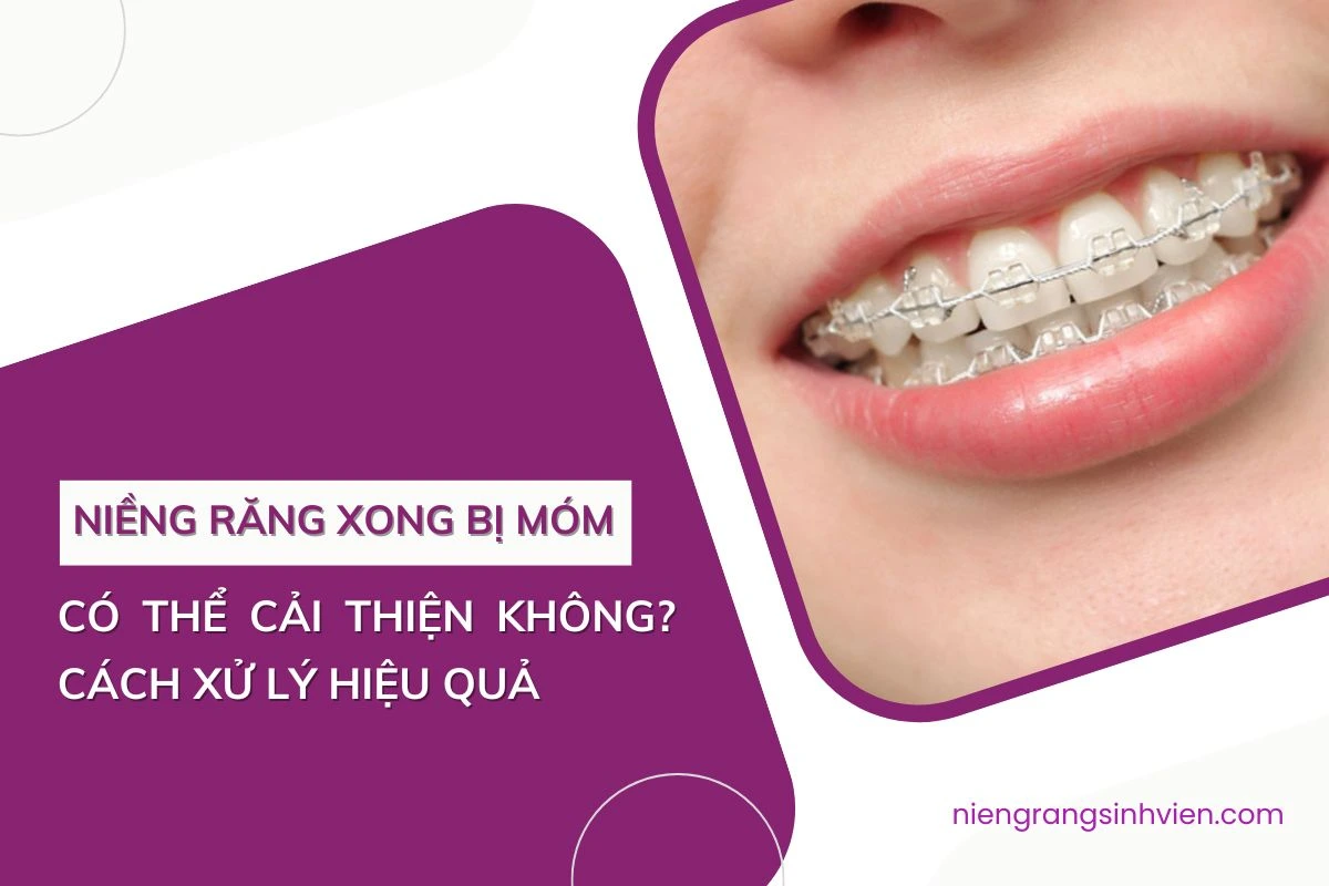 niềng răng xong bị móm