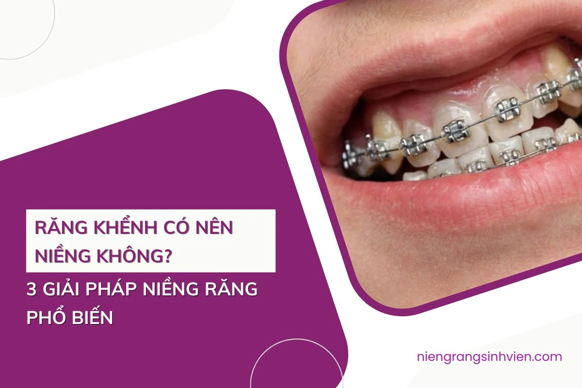 răng khểnh có nên niềng không