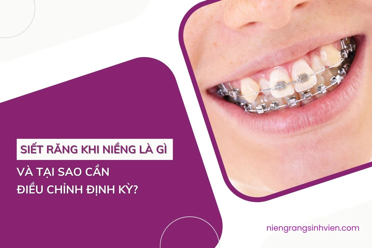 siết răng khi niềng